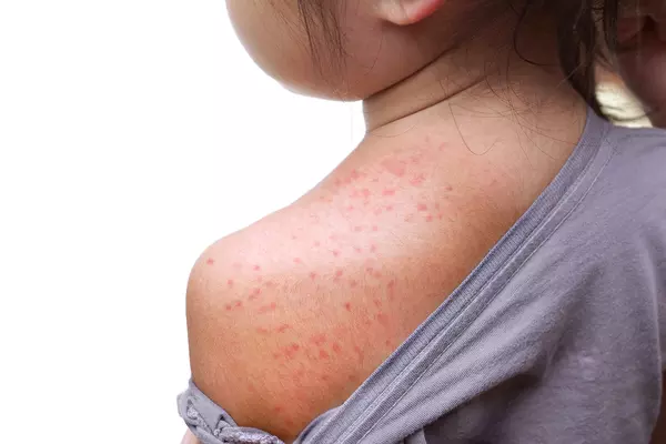 image of young girl's shoulder with red bumps